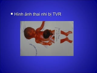  Hình ảnh thai nhi bị TVRHình ảnh thai nhi bị TVR
 