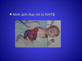  Hình ảnh thai nhi bị KHTBHình ảnh thai nhi bị KHTB
 