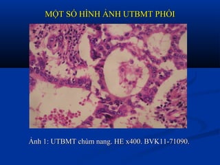 MỘT SỐ HÌNH ẢNH UTBMT PHỔIMỘT SỐ HÌNH ẢNH UTBMT PHỔI
Ảnh 1: UTBMT chùm nang. HE x400. BVK11-71090.Ảnh 1: UTBMT chùm nang. HE x400. BVK11-71090.
 