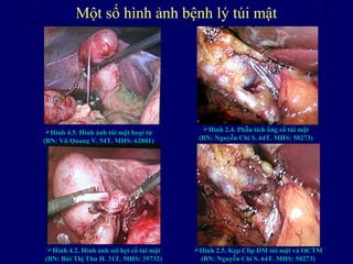 Một số hình ảnh bệnh lý túi mật
Hình 4.5. Hình ảnh túi mật hoại tử
(BN: Vũ Quang V. 54T. MHS: 62801)
Hình 4.2. Hình ảnh sỏi kẹt cổ túi mật
(BN: Bùi Thị Thu H. 31T. MHS: 35732)
Hình 2.5. Kẹp Clip ĐM túi mật và OCTM
(BN: Nguyễn Chí S. 64T. MHS: 50273)
Hình 2.4. Phẫu tích ống cổ túi mật
(BN: Nguyễn Chí S. 64T. MHS: 50273)
 