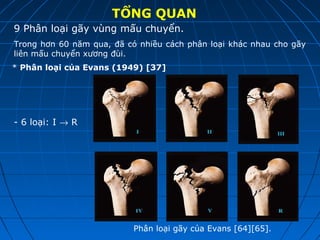 TỔNG QUAN
9 Phân loại gãy vùng mấu chuyển.
Trong hơn 60 năm qua, đã có nhiều cách phân loại khác nhau cho gãy
liên mấu chuyển xương đùi.
* Phân loại của Evans (1949) [37]
Phân loại gãy của Evans [64][65].
- 6 loại: I → R
 