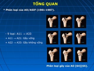 TỔNG QUAN
* Phân loại của AO/ASIF (1981-1987).
- 9 loại: A11 → A33
+ A11 → A21: Gãy vững
+ A22 → A33: Gãy không vững
Phân loại gãy của AO [64][65].
 