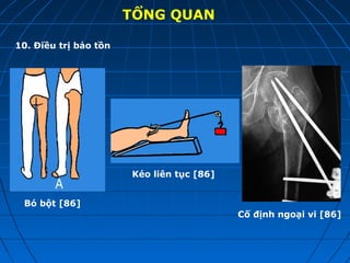 TỔNG QUAN
10. Điều trị bảo tồn
Bó bột [86]
Kéo liên tục [86]
Cố định ngoại vi [86]
 