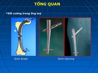TỔNG QUAN
*Kết xương trong ống tuỷ
Đinh Ender Đinh Gamma
 
