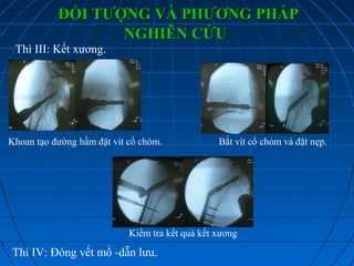 ĐỐI TƯỢNG VÀ PHƯƠNG PHÁPĐỐI TƯỢNG VÀ PHƯƠNG PHÁP
NGHIÊN CỨUNGHIÊN CỨU
Thì III: Kết xương.
Khoan tạo đường hầm đặt vít cổ chỏm. Bắt vít cổ chỏm và đặt nẹp.
Kiểm tra kết quả kết xương
Thì IV: Đóng vết mổ -dẫn lưu.
 