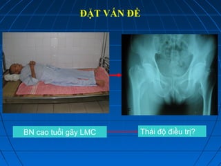 ĐẶT VẤN ĐỀ
BN cao tuổi gãy LMC Thái độ điều trị?
 