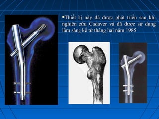Thiết bị này đã được phát triển sau khiThiết bị này đã được phát triển sau khi
nghiên cứu Cadaver và đã được sử dụngnghiên cứu Cadaver và đã được sử dụng
lâm sàng kể từ tháng hai năm 1985lâm sàng kể từ tháng hai năm 1985
 