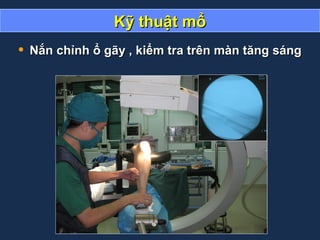 Kỹ thuật mổKỹ thuật mổ
• Nắn chỉnh ổ gãy , kiểm tra trên màn tăng sángNắn chỉnh ổ gãy , kiểm tra trên màn tăng sáng
 