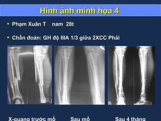 Hình ảnh minh họa 4Hình ảnh minh họa 4
• Phạm Xuân T nam 28tPhạm Xuân T nam 28t
• Chẩn đoán: GH độ IIIA 1/3 giữa 2XCC PhảiChẩn đoán: GH độ IIIA 1/3 giữa 2XCC Phải
 
