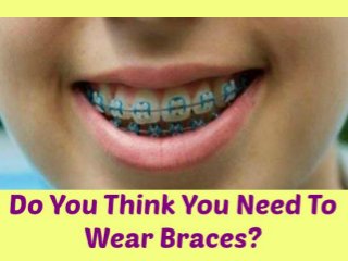 Do you Think You Need To Wear Braces?