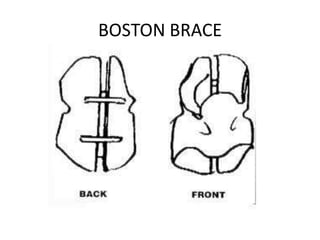 BOSTON BRACE

 