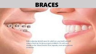 BRACES
Before placing dental braces for adults on your teeth you will
need a check-up for decay or gum problems. Do visit your
dentist or the School Dental Clinic regularly, even when you are
on braces.
 