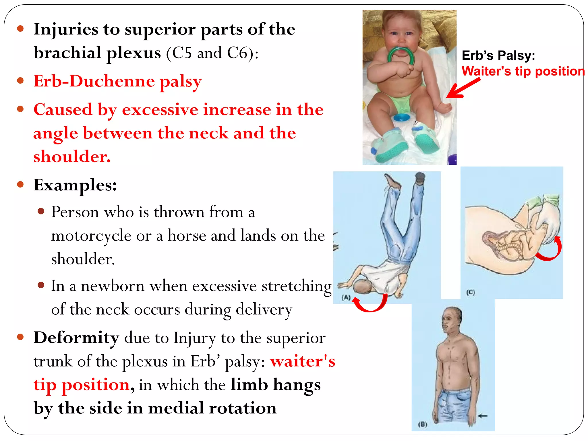  Injuries to superior parts of the
brachial plexus (C5 and C6):
 Erb-Duchenne palsy
 Caused by excessive increase in the
angle between the neck and the
shoulder.
 Examples:
 Person who is thrown from a
motorcycle or a horse and lands on the
shoulder.
 In a newborn when excessive stretching
of the neck occurs during delivery
 Deformity due to Injury to the superior
trunk of the plexus in Erb’ palsy: waiter's
tip position, in which the limb hangs
by the side in medial rotation
Erb’s Palsy:
Waiter's tip position
 
