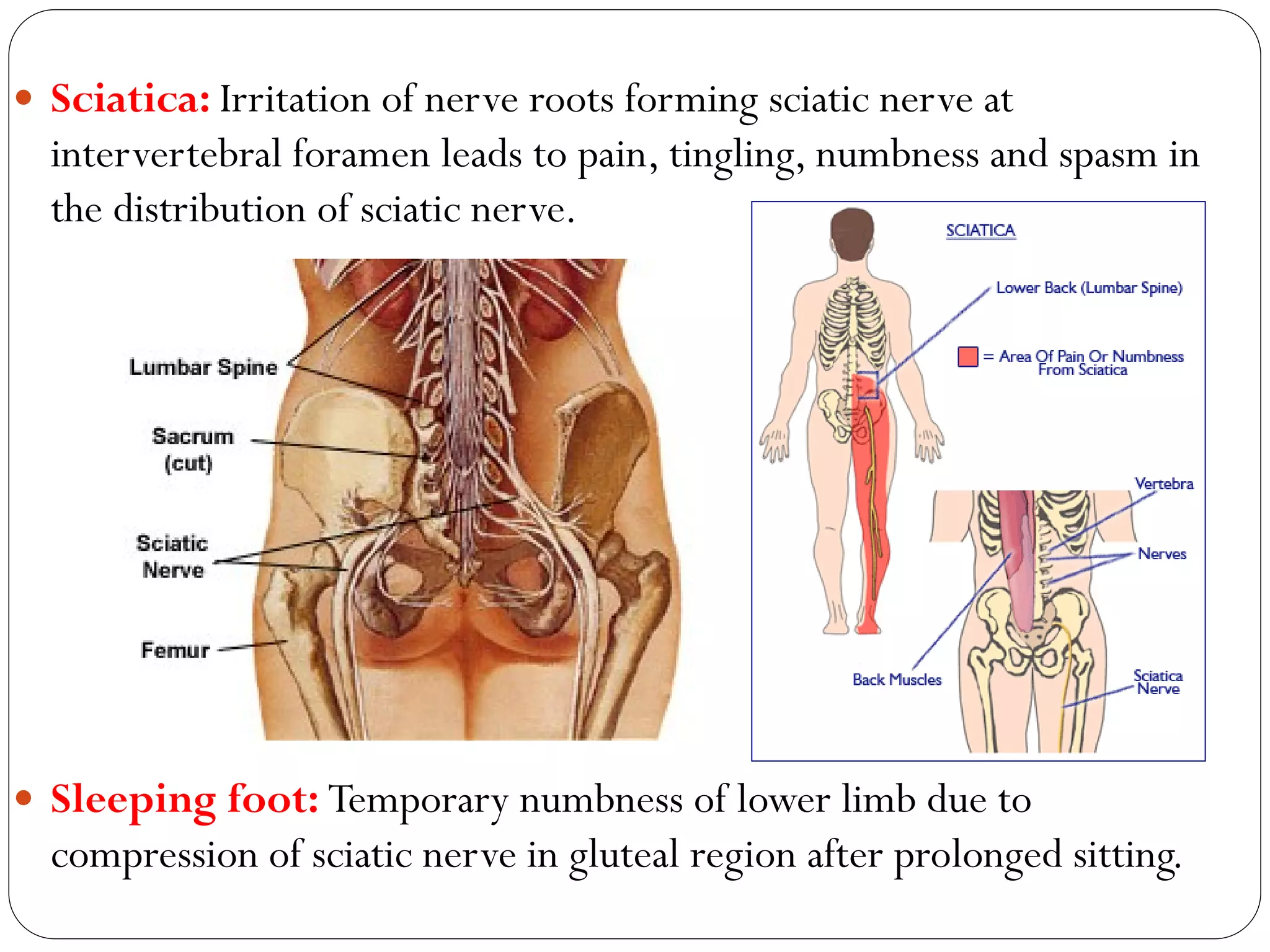  Sciatica: Irritation of nerve roots forming sciatic nerve at
intervertebral foramen leads to pain, tingling, numbness and spasm in
the distribution of sciatic nerve.
 Sleeping foot: Temporary numbness of lower limb due to
compression of sciatic nerve in gluteal region after prolonged sitting.
 
