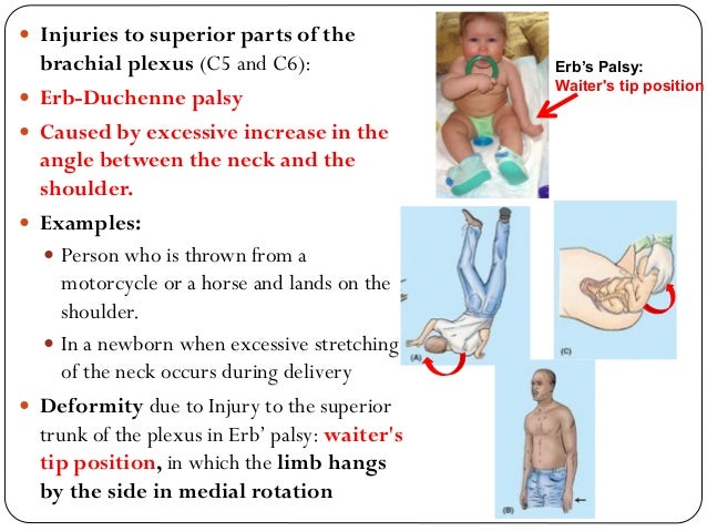 waiters tip deformity 8 quick tips regarding waiters tip erb duchenne