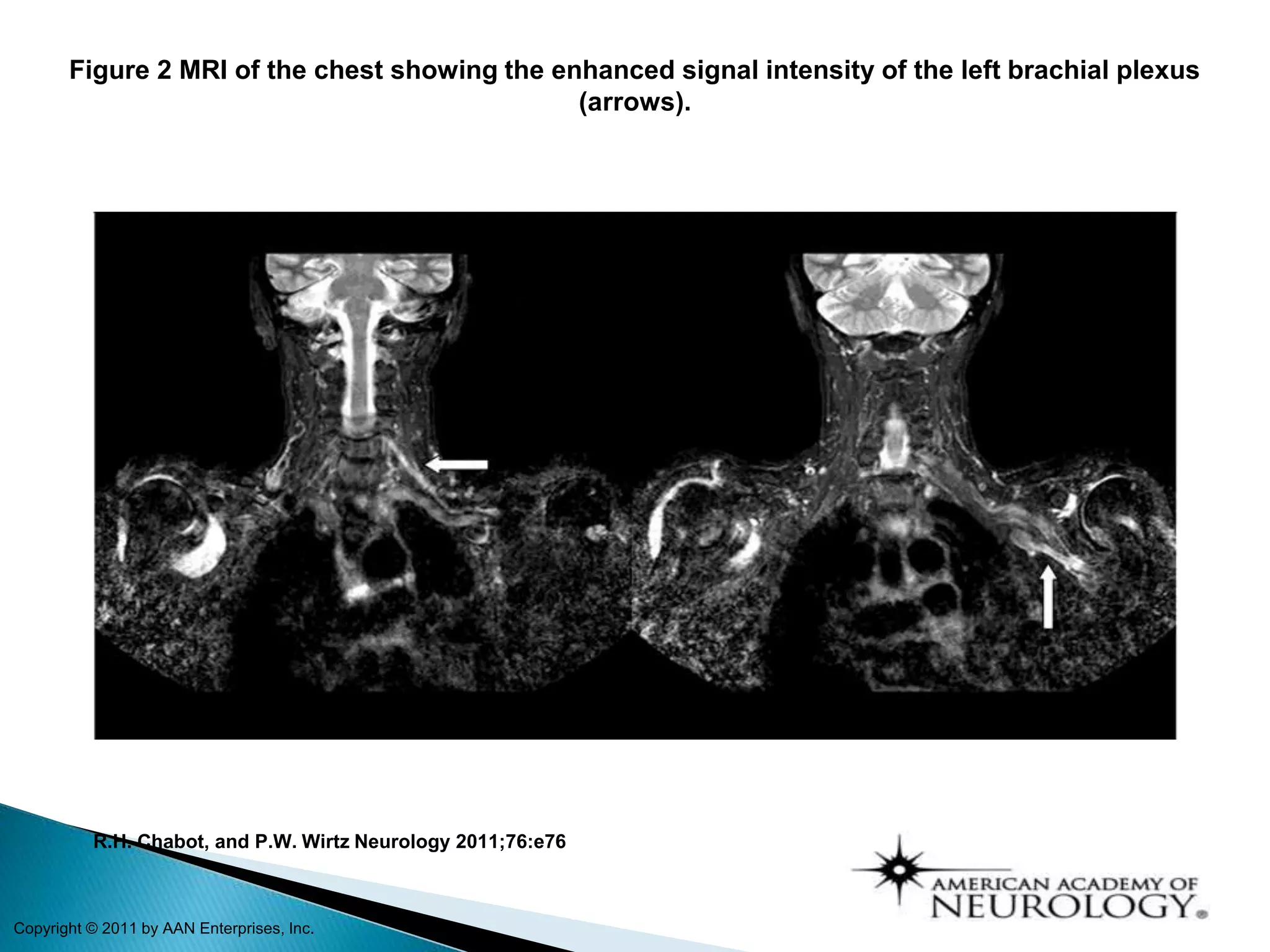 Figure 2 MRI of the chest showing the enhanced signal intensity of the left brachial plexus
(arrows).
R.H. Chabot, and P.W. Wirtz Neurology 2011;76:e76
Copyright © 2011 by AAN Enterprises, Inc.
 