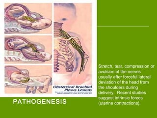 Stretch, tear, compression or
avulsion of the nerves
usually after forceful lateral
deviation of the head from
the shoulders during
delivery. Recent studies
suggest intrinsic forces
(uterine contractions).PATHOGENESIS
 