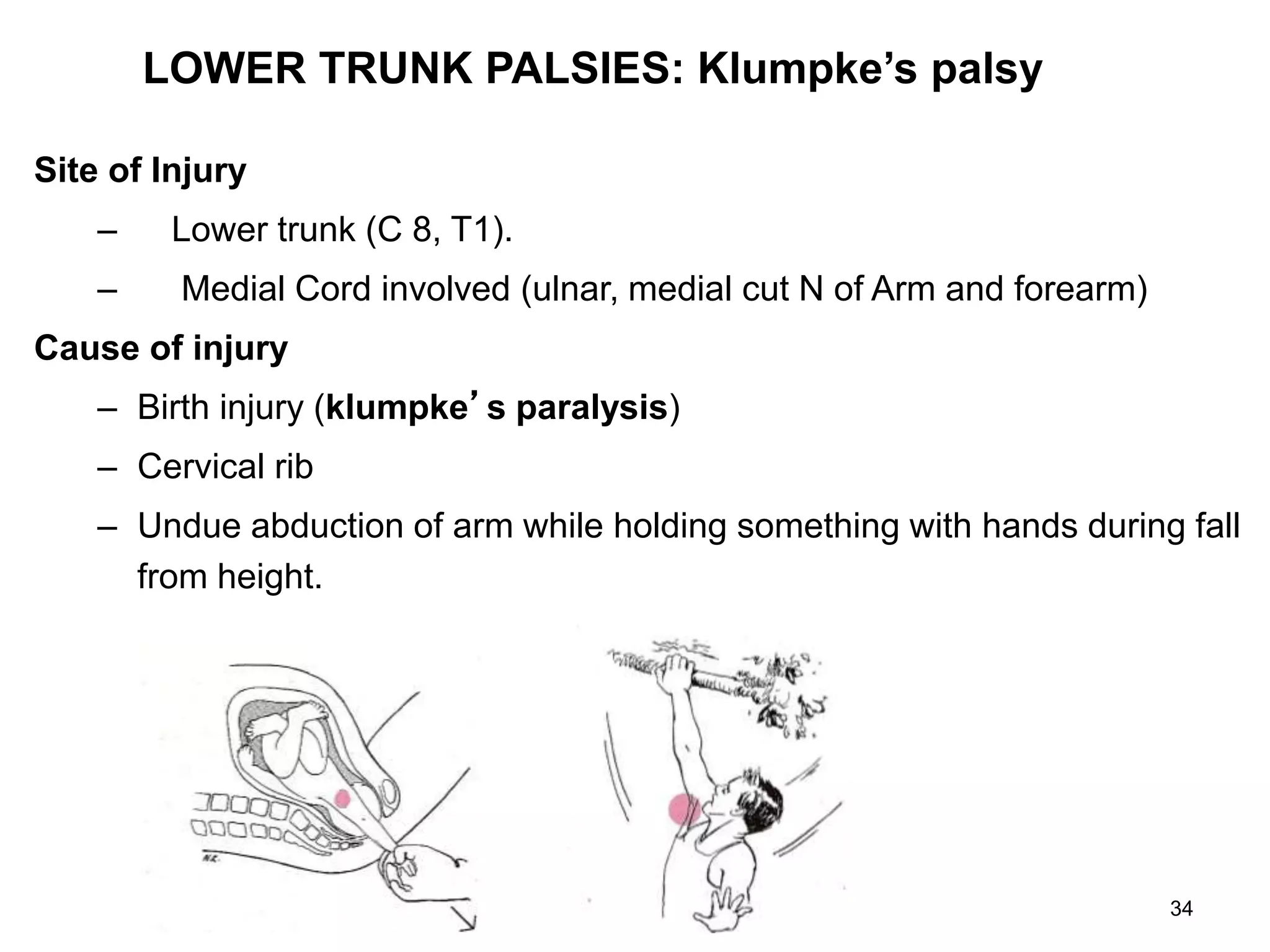 LOWER TRUNK PALSIES: Klumpke’s palsy
Site of Injury
– Lower trunk (C 8, T1).
– Medial Cord involved (ulnar, medial cut N of Arm and forearm)
Cause of injury
– Birth injury (klumpke’s paralysis)
– Cervical rib
– Undue abduction of arm while holding something with hands during fall
from height.
34
 