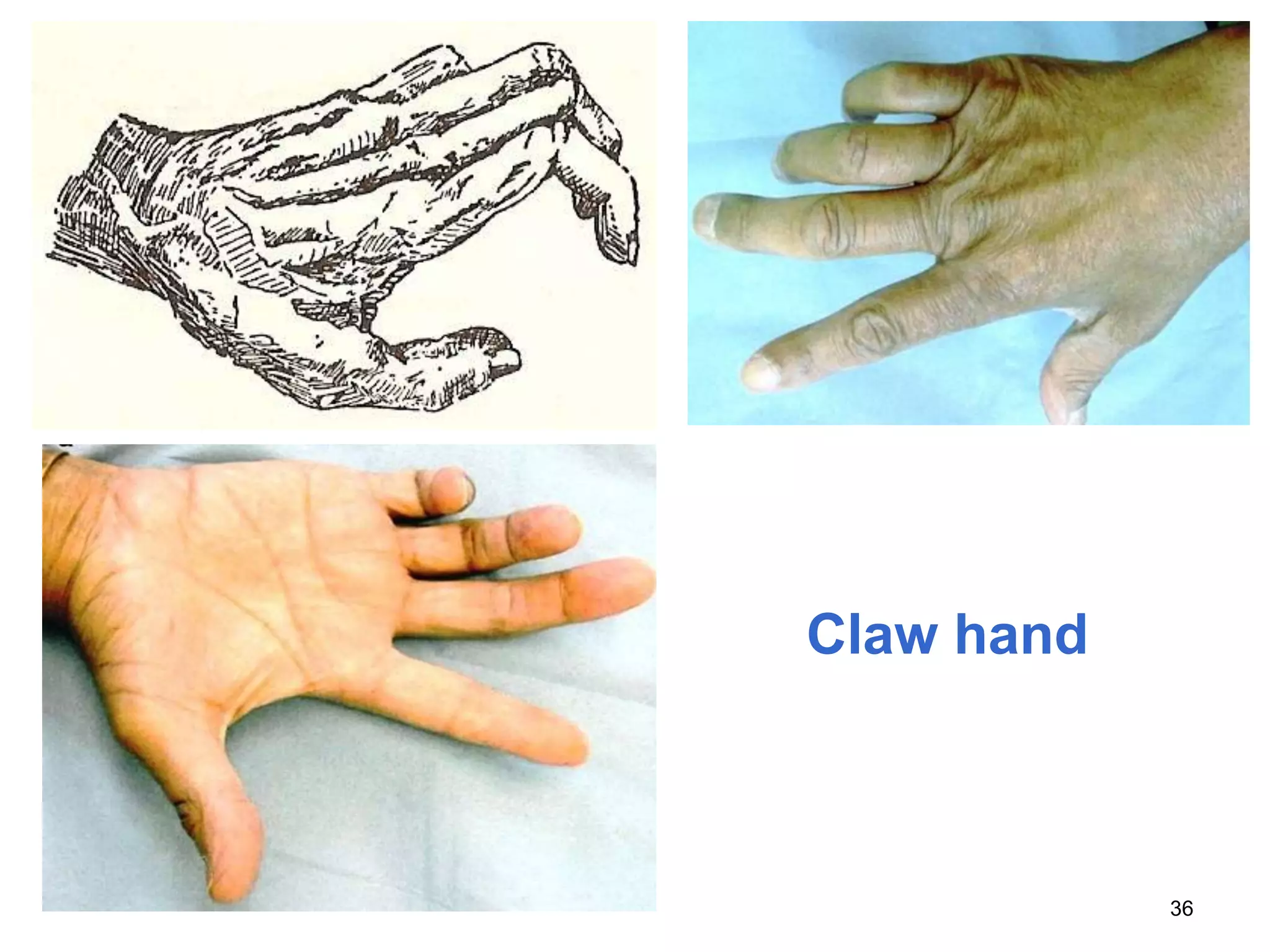Claw hand
36
 