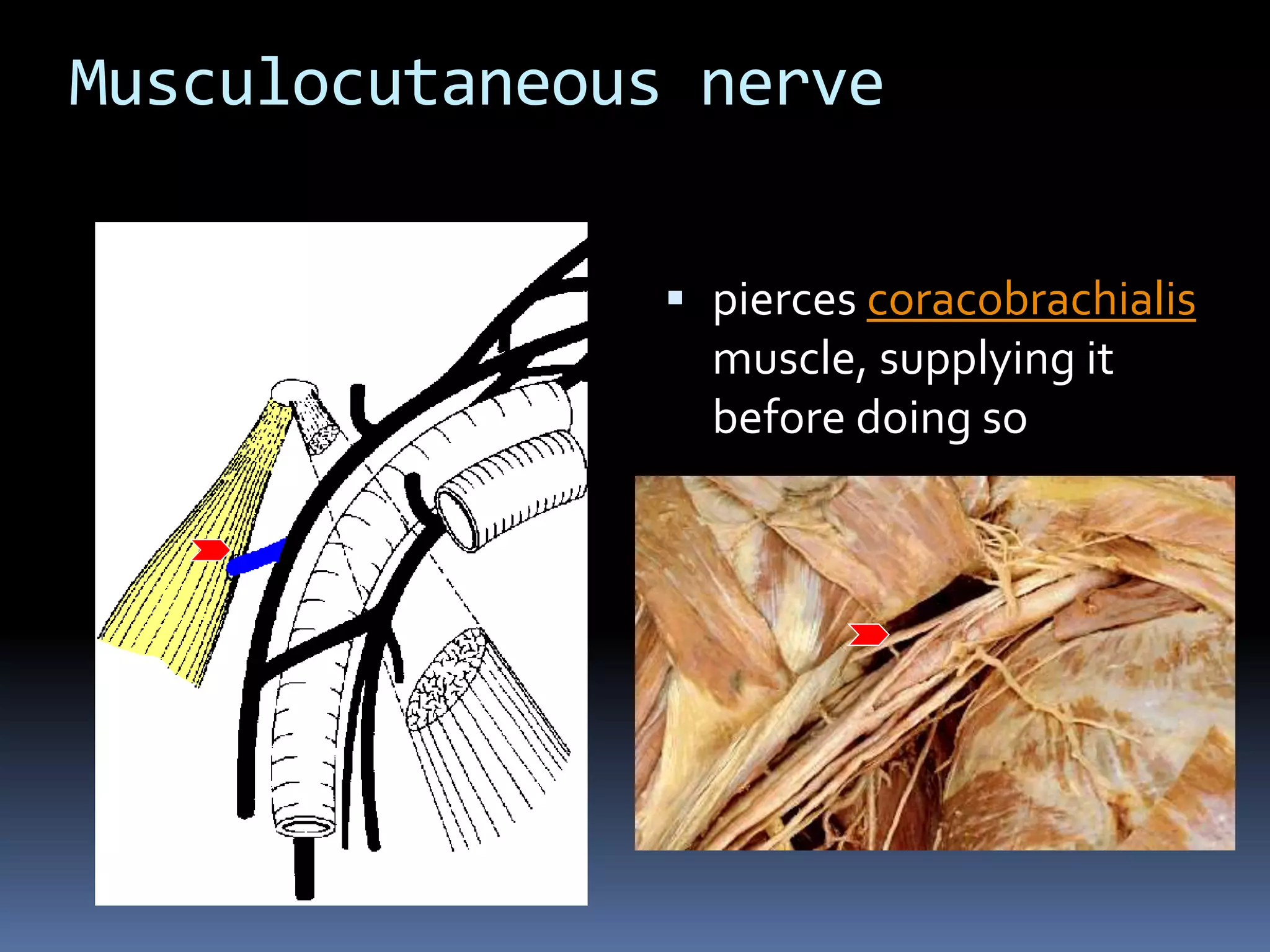 Musculocutaneous nerve
 pierces coracobrachialis
muscle, supplying it
before doing so
 
