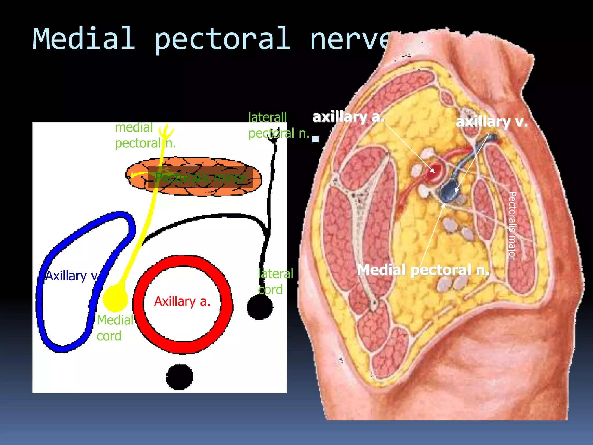 Medial pectoral nerve
 The medial pectoral
nerve passes through
pectoralis minor
supplying it then it
supplies pectoralis
major
Axillary a.
Pectoralis minor
medial
pectoral n.
laterall
pectoral n.
Medial
cord
lateral
cord
Axillary v.
axillary a. axillary v.
Medial pectoral n.
Pectoralismajor
 