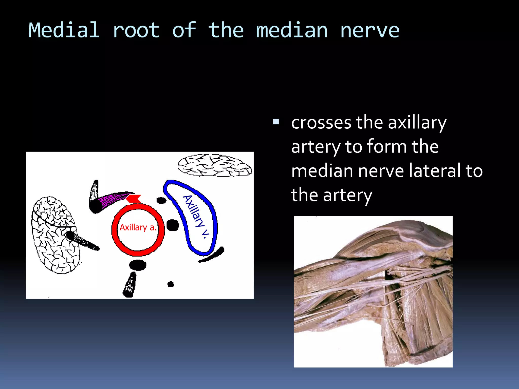 Medial root of the median nerve
 crosses the axillary
artery to form the
median nerve lateral to
the artery
Axillary a.
 