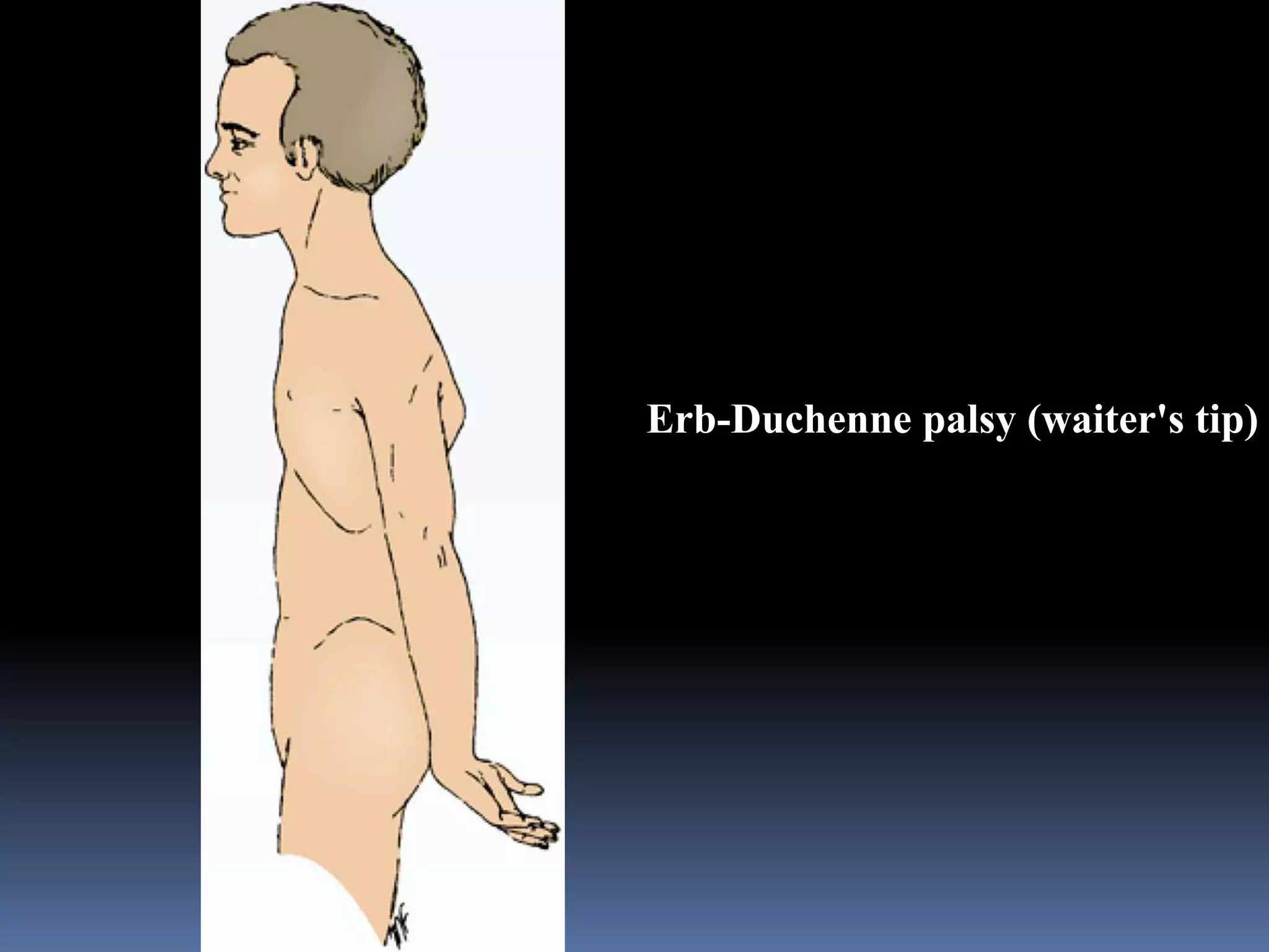 Erb-Duchenne palsy (waiter's tip)
 