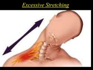 Excessive Stretching
 
