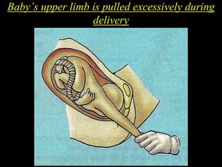 Baby’s upper limb is pulled excessively during
delivery
 