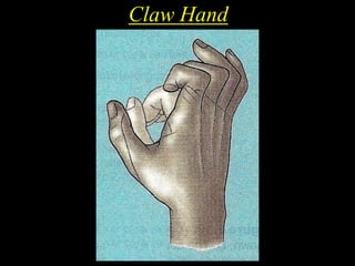 Claw Hand
 