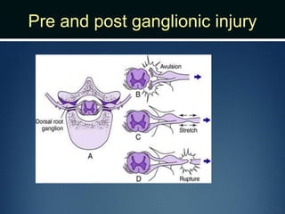 Pre and post ganglionic injury
 