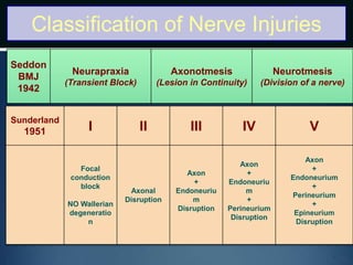Classification of Nerve Injuries
Seddon
BMJ
1942
Neurapraxia
(Transient Block)
Axonotmesis
(Lesion in Continuity)
Neurotmesis
(Division of a nerve)
Sunderland
1951 I II III IV V
Focal
conduction
block
NO Wallerian
degeneratio
n
Axonal
Disruption
Axon
+
Endoneuriu
m
Disruption
Axon
+
Endoneuriu
m
+
Perineurium
Disruption
Axon
+
Endoneurium
+
Perineurium
+
Epineurium
Disruption
 
