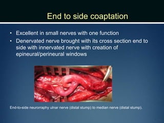 End to side coaptation
• Excellent in small nerves with one function
• Denervated nerve brought with its cross section end to
side with innervated nerve with creation of
epineural/perineural windows
End-to-side neurorraphy ulnar nerve (distal stump) to median nerve (distal stump).
 