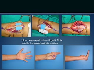 Ulnar nerve repair using allograft. Note
excellent return of intrinsic function.
 