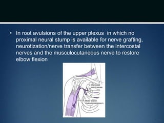 • In root avulsions of the upper plexus in which no
proximal neural stump is available for nerve grafting,
neurotization/nerve transfer between the intercostal
nerves and the musculocutaneous nerve to restore
elbow flexion
 