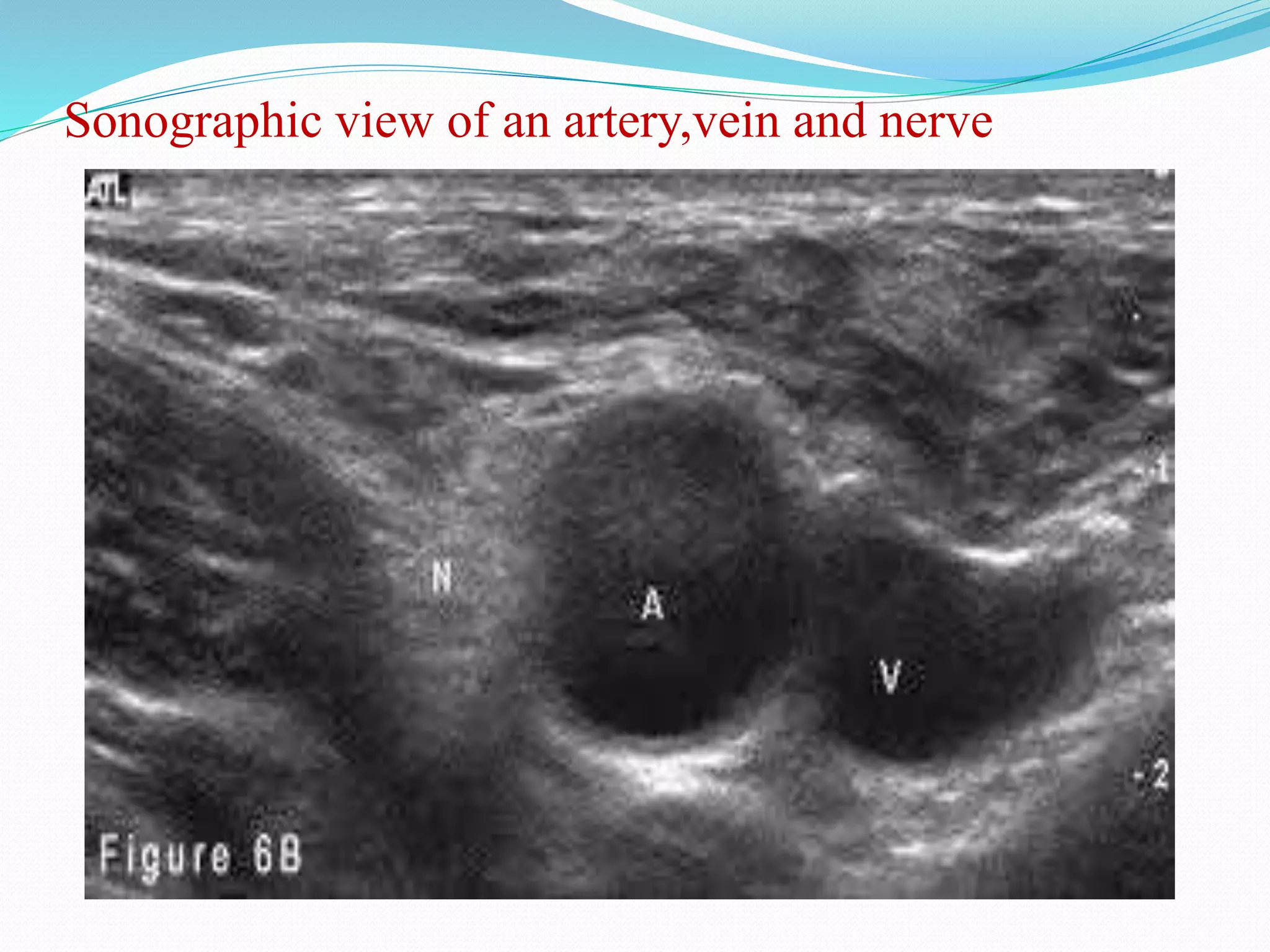 Sonographic view of an artery,vein and nerve
 