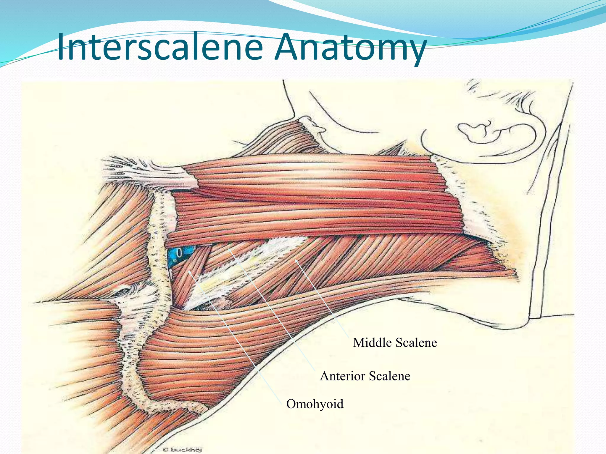 Interscalene Anatomy
SCM
Middle Scalene
Anterior Scalene
Omohyoid
 