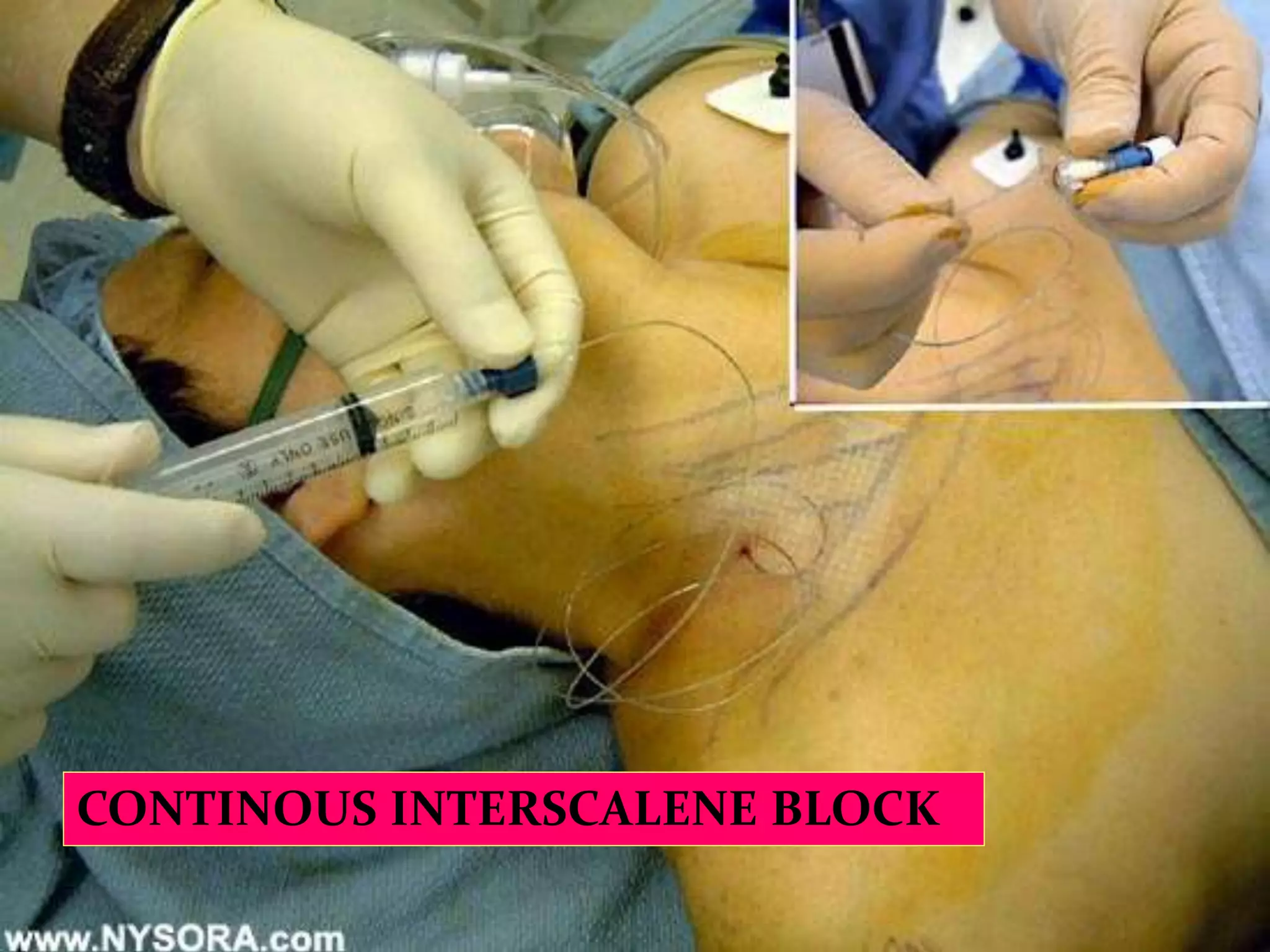 P.N.REDDY-HYCOME 2004
CONTINOUS INTERSCALENE BLOCK
 