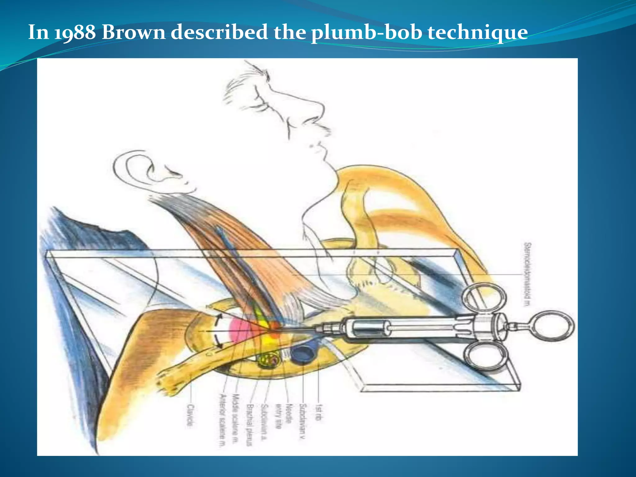 In 1988 Brown described the plumb-bob technique
 