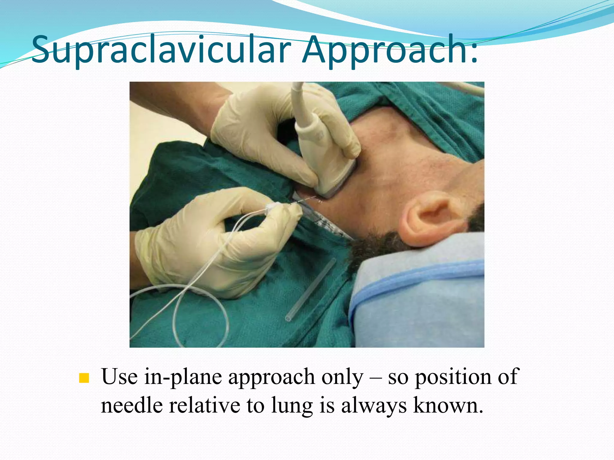 Supraclavicular Approach:
 Use in-plane approach only – so position of
needle relative to lung is always known.
 