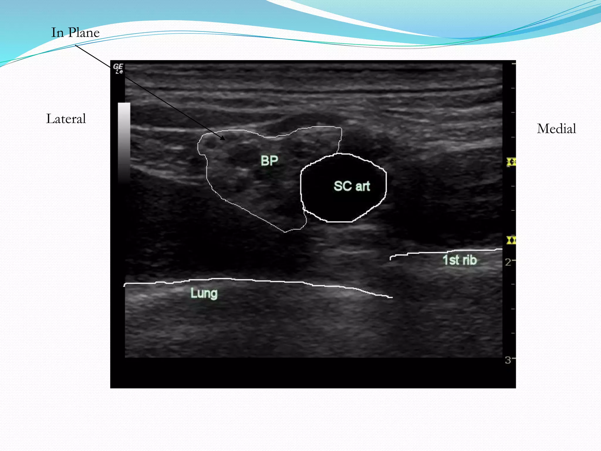 In Plane
Medial
Lateral
 