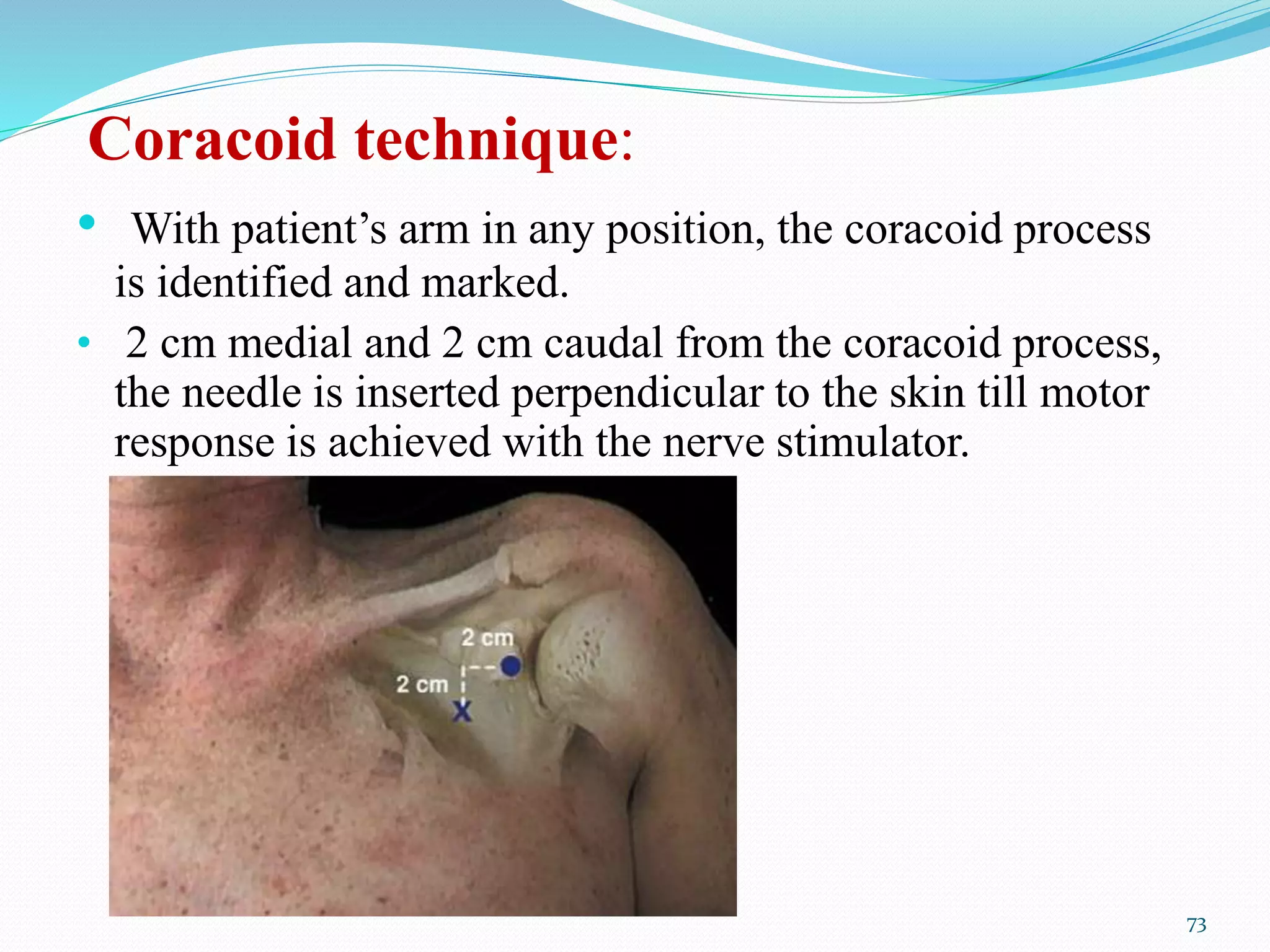 Coracoid technique:
• With patient’s arm in any position, the coracoid process
is identified and marked.
• 2 cm medial and 2 cm caudal from the coracoid process,
the needle is inserted perpendicular to the skin till motor
response is achieved with the nerve stimulator.
73
 