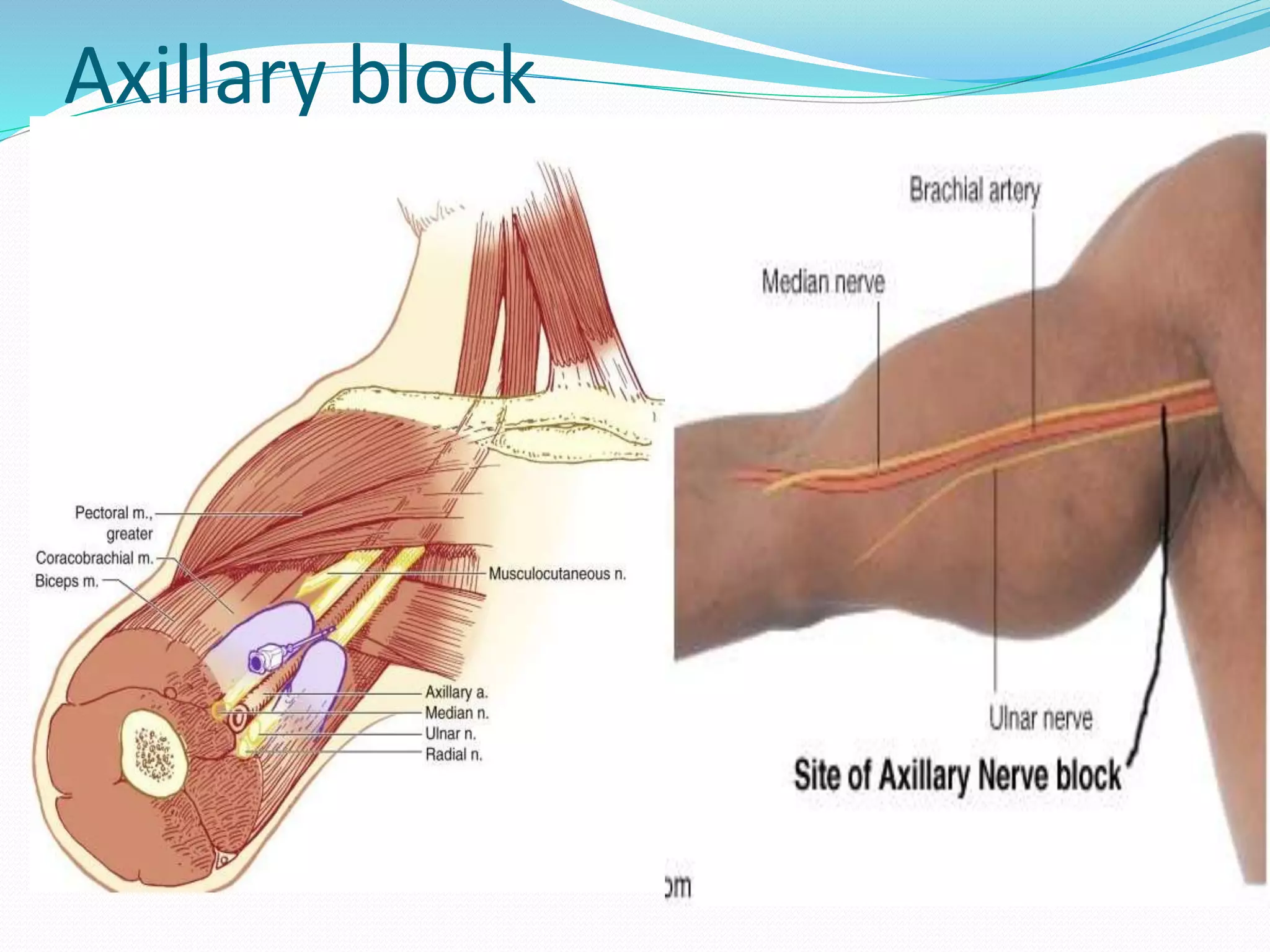 Axillary block
 
