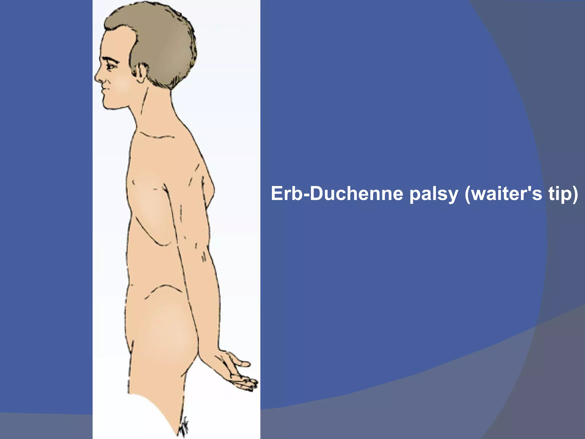 Erb-Duchenne palsy (waiter's tip)
 
