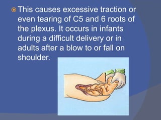 Fall Plexus Event Brachialplexusinjuries | PPTX