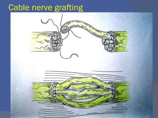 Cable nerve grafting
 