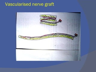 Vascularised nerve graft
 