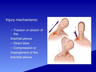 Injury mechanisms:
– Traction or stretch of
the
brachial plexus
– Direct blow
– Compression or
impingement of the
brachial plexus
 
