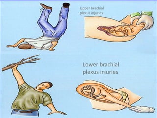 Lower brachial
plexus injuries
Upper brachial
plexus injuries
 