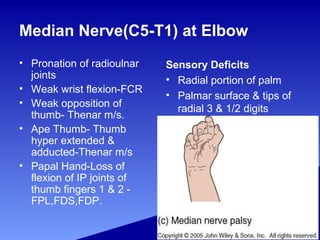 Median Nerve(C5-T1) at Elbow
• Pronation of radioulnar
joints
• Weak wrist flexion-FCR
• Weak opposition of
thumb- Thenar m/s.
• Ape Thumb- Thumb
hyper extended &
adducted-Thenar m/s
• Papal Hand-Loss of
flexion of IP joints of
thumb fingers 1 & 2 -
FPL,FDS,FDP.
Sensory Deficits
• Radial portion of palm
• Palmar surface & tips of
radial 3 & 1/2 digits
 